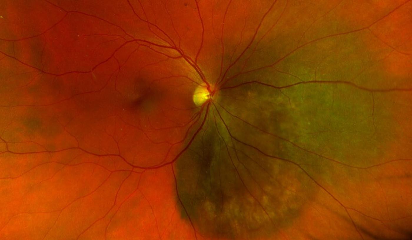 Rétinophotographie OPTOS montrant un mélanome choroïdien nasal avec masse pigmentée et fluide sous-rétinien associé